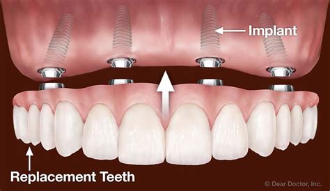 Fixed Dentures | J. A. Lewandowski, D.D.S. | Leawood Kansas