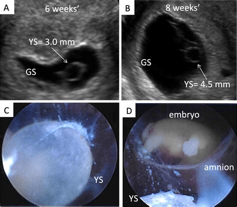 Amniotic Sac Ultrasound