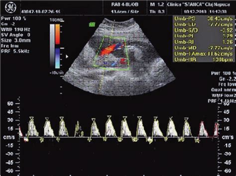 Umbilical Artery Doppler Normal Values