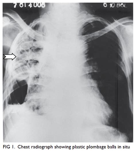 Plombage treatment for pulmonary tuberculosis in Hong Kong | HKMJ