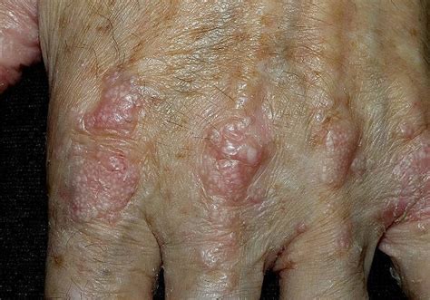 Epidermolysis bullosa acquisita