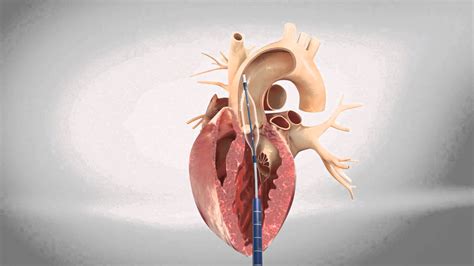 Undertsanding A Transcatheter Aortic Valve Replacement (TAVR) - Central Georgia Heart Center