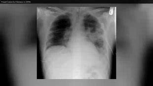 Cystic fibrosis - Wikipedia