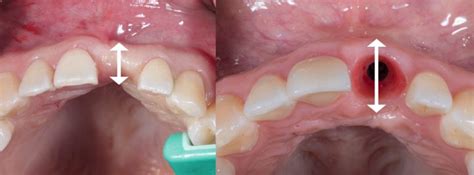 RIDGE AUGMENTATION - IMPLANT PERIO CENTER