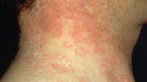 Is That Rash Psoriasis? Psoriasis Pictures and More | Everyday Health