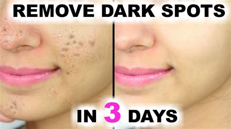 In 3 DAYS - Remove Dark Spots, Black Spots & Acne Scars - ArtsyCraftsyDad