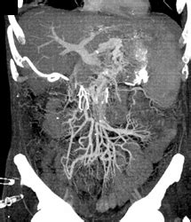 Engorged Mesenteric Vessels - Vascular Case Studies - CTisus CT Scanning