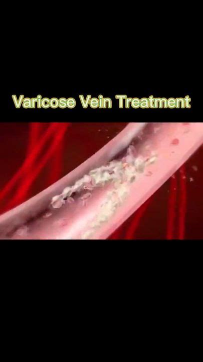 HBESTY varicose veins ointment/Leg varicose removal ointment/Analgesic anti-varicose veins leg ...