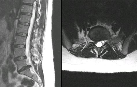 Herniated Disc Mri L5 S1 - Lumbar Herniated Disc - A More in Depth Look - Why does disc bulge or ...