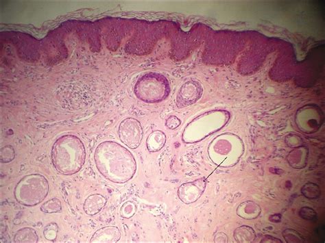 Steatocystoma Multiplex Histology