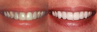 Before After 2 | 6 Veneers were used to dramatically improve… | Flickr