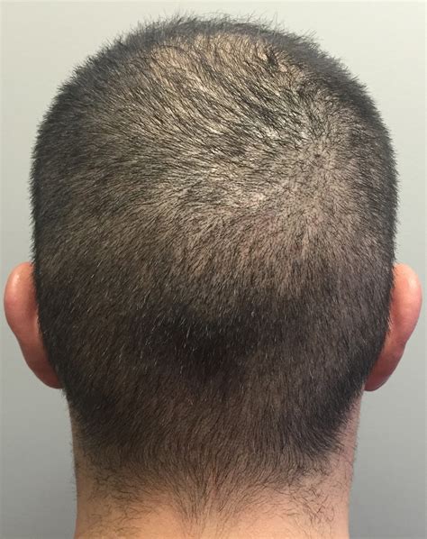 FUE Hair Transplant After 1 Week | Marc Dauer, MD Hair Transplant Doctor Los Angeles