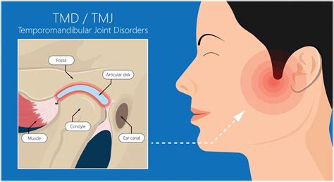 TMJ Pain Worcester MA | TMJ Treatment Billerica | TMJ Disorder