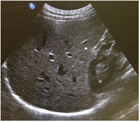 Ultrasound in the assessment of hepatomegaly: A simple technique to determine an enlarged liver ...