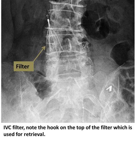 IVC Filter Placement - IVC Filter | UCLA Health