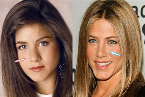 Has Jennifer Aniston Had Plastic Surgery? (Before & After 2018)