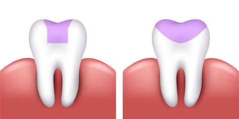 Inlays and Onlays - Back 2 Basics Dentistry | Clarksville TN