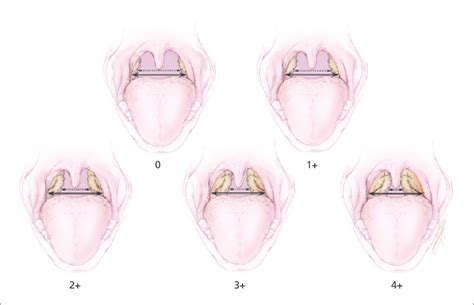 Tonsillar Hypertrophy Score