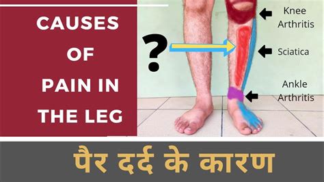 Causes of Leg Pain | Shin Splint | Calf strain | Sciatica | Varicose Veins | पैर में दर्द के ...