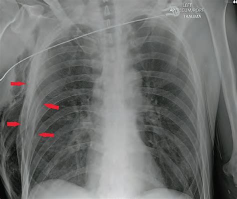 Flail Chest X Ray