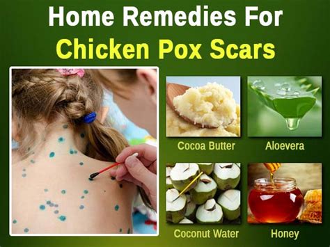 Home Remedies To Get Rid Of Chicken Pox Scars - Boldsky.com