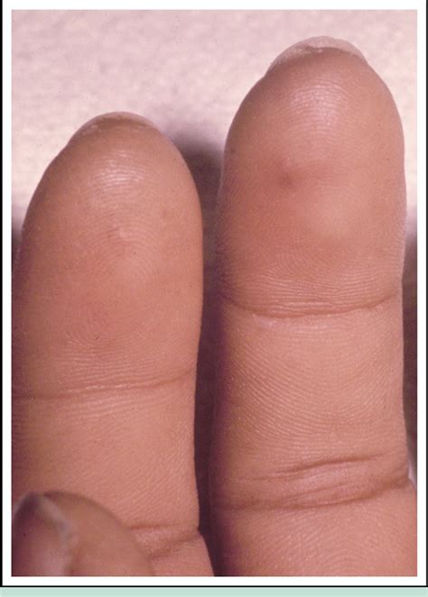 Figure 1 from Osler's nodes and Janeway lesions. | Semantic Scholar