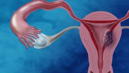 Endometrial Cancer: Symptoms To Know – Entirely Health