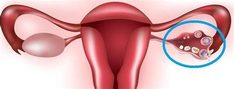 What is an Ovarian Dermoid and Why Does It Grow Teeth!? – Mama Doctor Jones