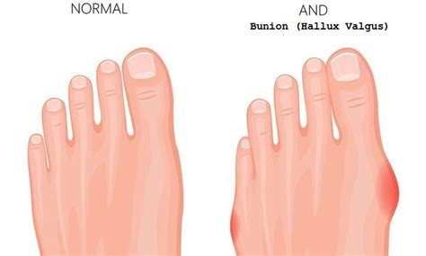 Footnotes Hallux Valgus Treatment | Kinvara Hospital