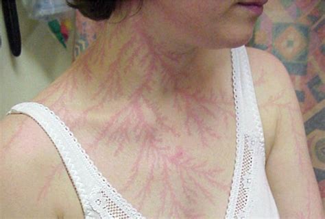 These Lightning Scars Explain What The Natural Disaster Does To Your Skin