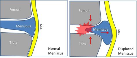 What Happens When Knee Meniscus Displaces From Surgery? The Outside of ...