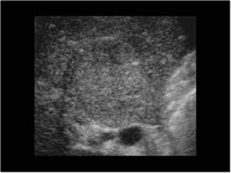 Abdomen and retroperitoneum | 1.1 Liver : Case 1.1.1 Focal nodular ...