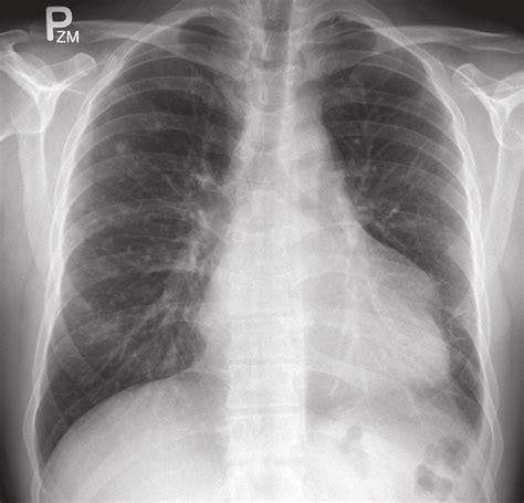 Normal Vs Abnormal Chest X Ray