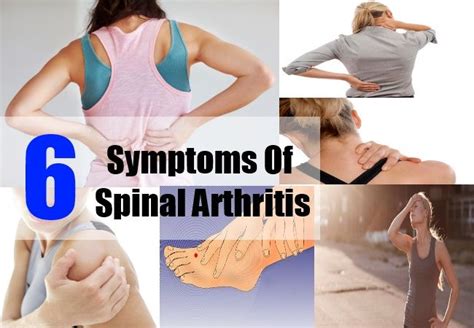 arthritis of the spine - Google Search | Arthritis, Rheumatoide arthritis symptome, Rheumatische ...