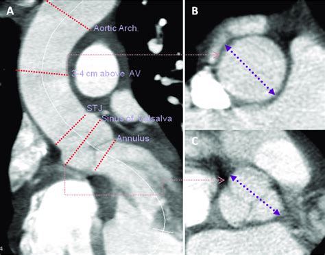 Thoracic Aortic Aneurysm CT