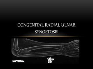 Congenital Radial Ulnar Synostosis.pptx