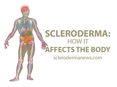 Systemic Sclerosis