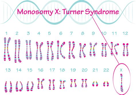 Turner Syndrome Karyotype Monosomy X 7818639 Vector Art at Vecteezy