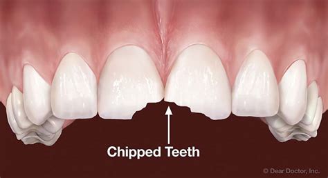 Cracked Teeth | The Office of Dr. John Sudick | Whittier California