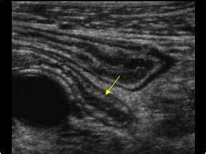 Abdomen and retroperitoneum | 1.5 Appendix : Case 1.5.1 Normal appendix | Ultrasound Cases