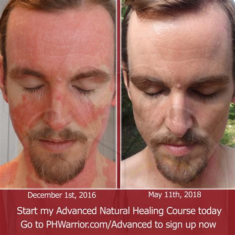 healing-before-after-face-psoriasis-2 - A Warrior Curing Psoriasis Naturally