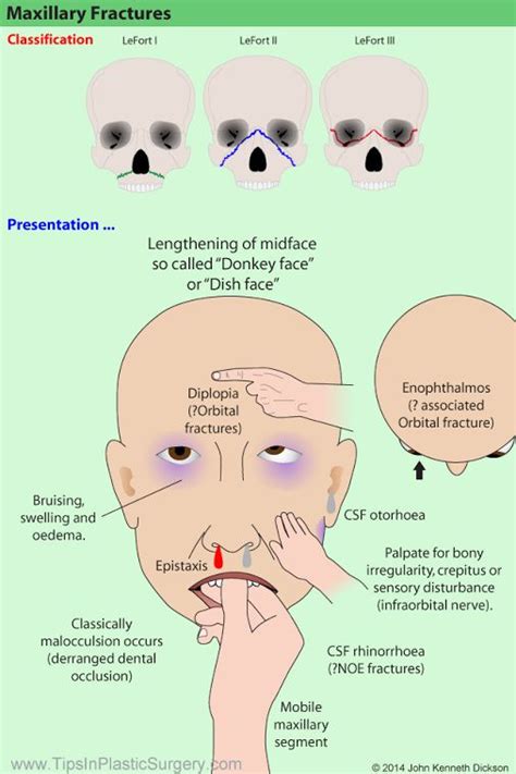 Best le fort fracture surgery in mumbai - toolbofrosdX