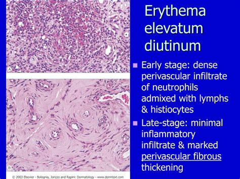 PPT - Cutaneous Vascular Diseases PowerPoint Presentation - ID:308625