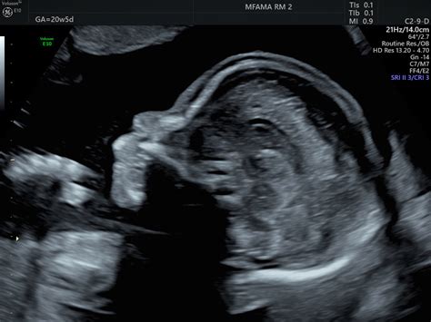 Anatomy Ultrasound | Maternal Fetal Associates of the Mid-Atlantic
