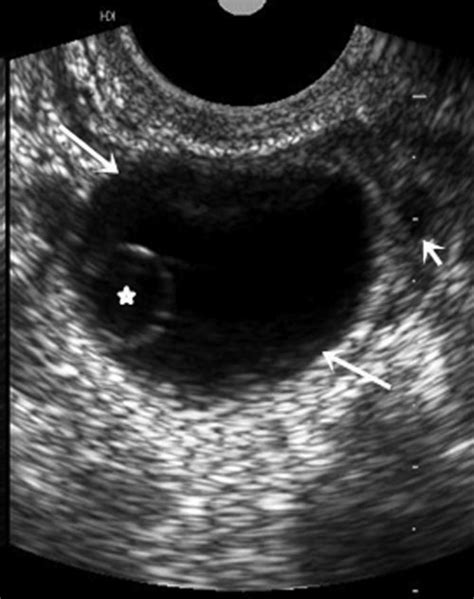 A 26-year-old female with ovarian pregnancy who presented with 6 weeks'... | Download Scientific ...