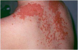 Maculopapular Rash - Pictures, Causes, Treatment, Definition, Signs