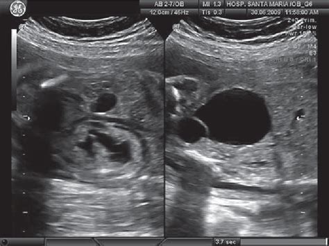 Figure 1 from Ureterocele: Antenatal Diagnosis and Management ...