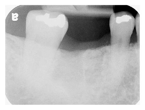 Preoperative views: (a) intraoral; (b) periapical radiograph. | Download Scientific Diagram