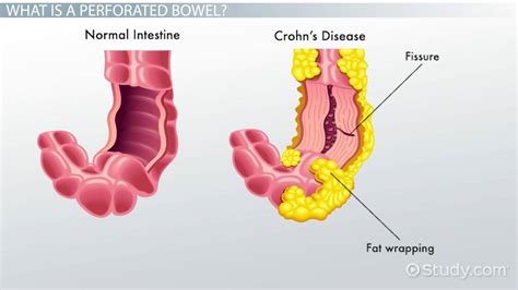 Perforated Bowel | Definition, Symptoms & Causes - Lesson | Study.com