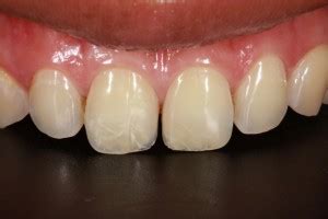 Cracked Tooth: Causes and Treatment in Williamsburg Williamsburg Dental